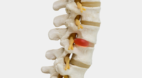 Pflugerville chiropractic conservative care helps even huge disc herniations go away