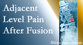 Pflugerville Wellness Center offers relieving care non-surgically to back pain patients suffering with adjacent level pain after spinal fusion surgery.